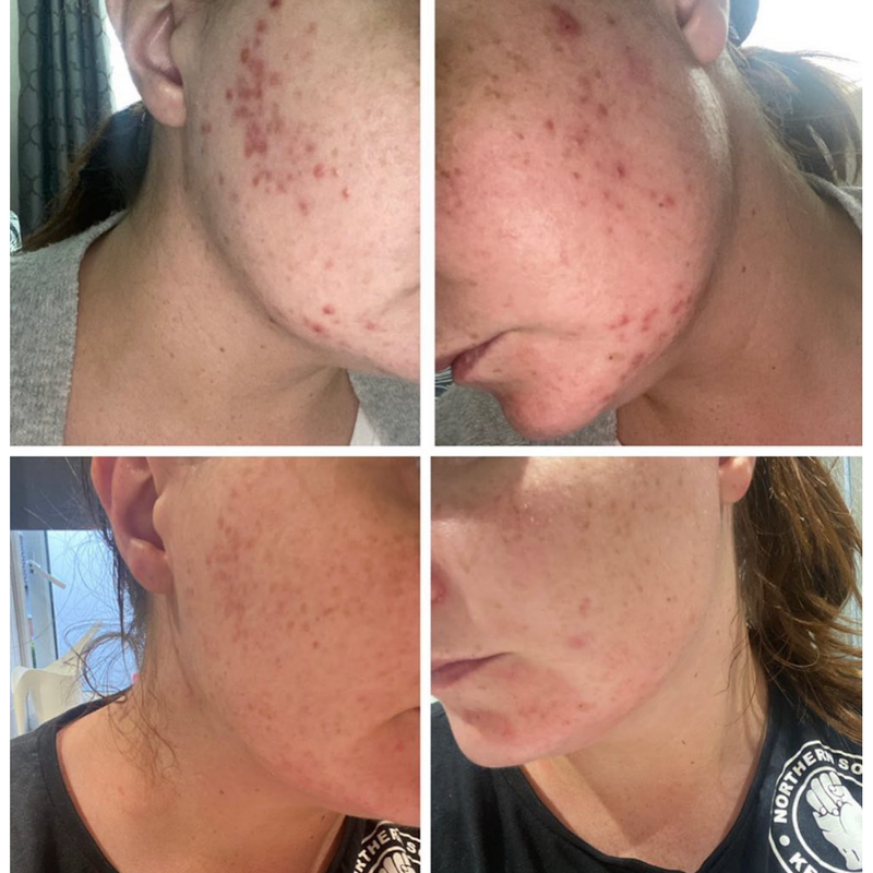 Breakout Kit | Skincare Routine for Blemish-Prone & Dehydrated Skin