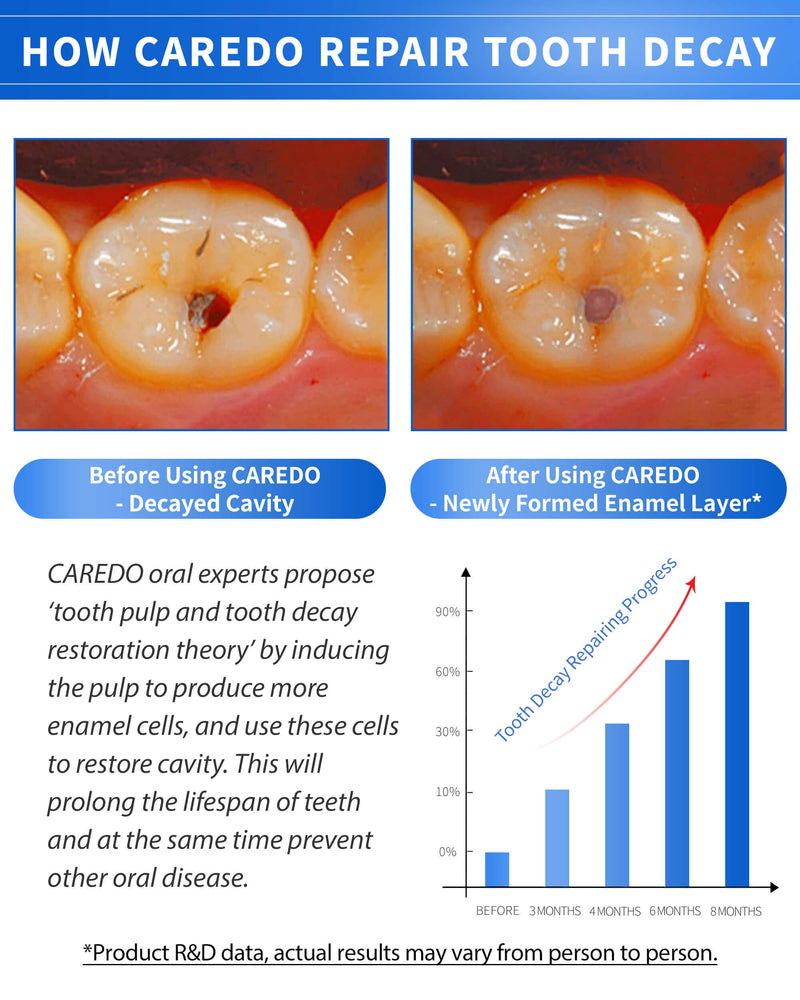 CAREDO Cavity Repair Toothpaste Set – 100g Hydroxyapatite + 16g Pulpitis Ointment