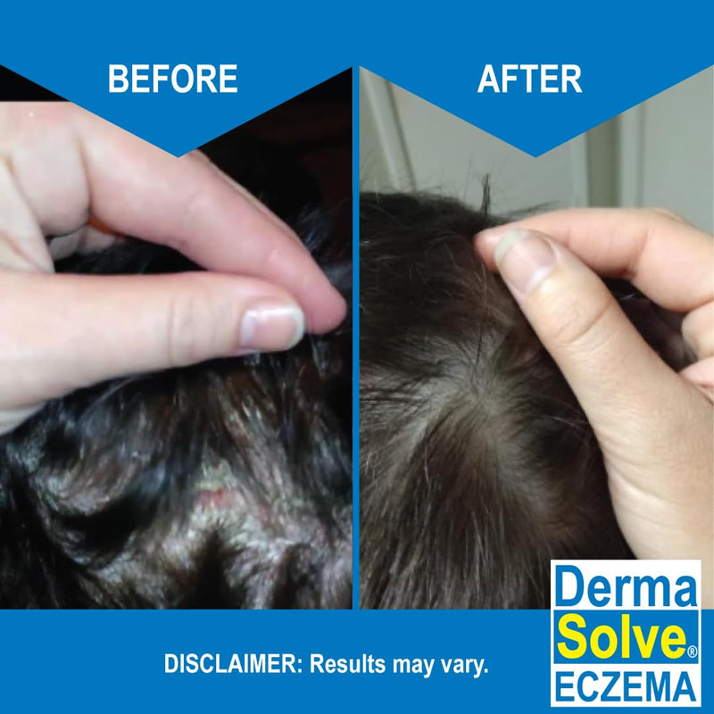 Dermasolve Eczema Shampoo & Conditioner Combo Pack – Steroid-Free for Kids & Adults