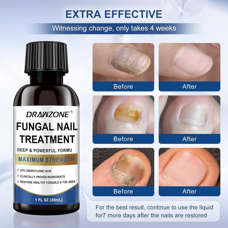 Drawzone Toenail Fungus Treatment Extra Strength – 25% Undecylenic Acid, Nail Renewal