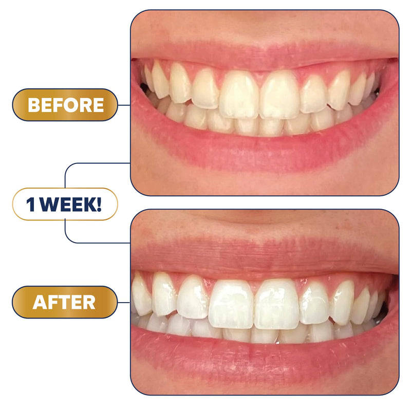 Lumineux Ultimate Whitening Kit Bundle – Enamel Safe & Clinically Proven