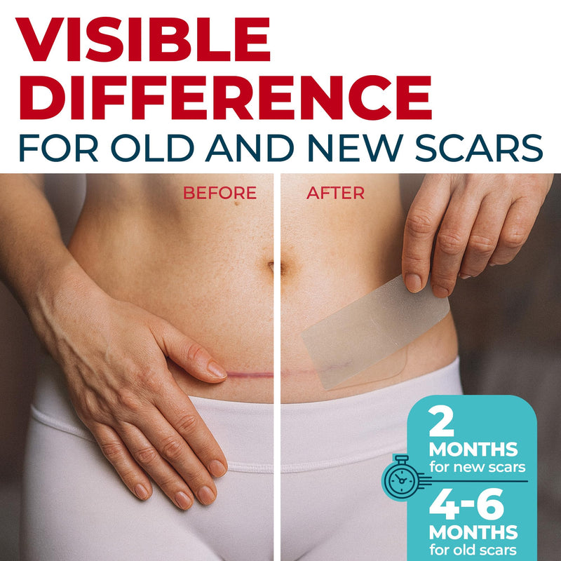 MYHELP Medical Grade Silicone Scar Tape - Transparent 1.6in x 120in for Surgical & Keloid Scars