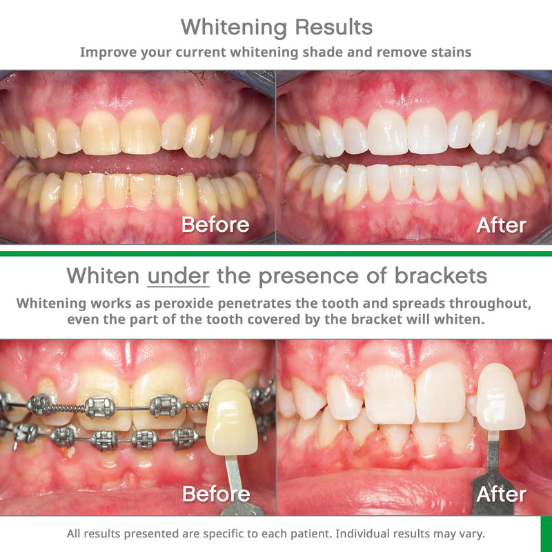 Opalescence Whitening Bundle: Go 10% Trays & Mint Toothpaste