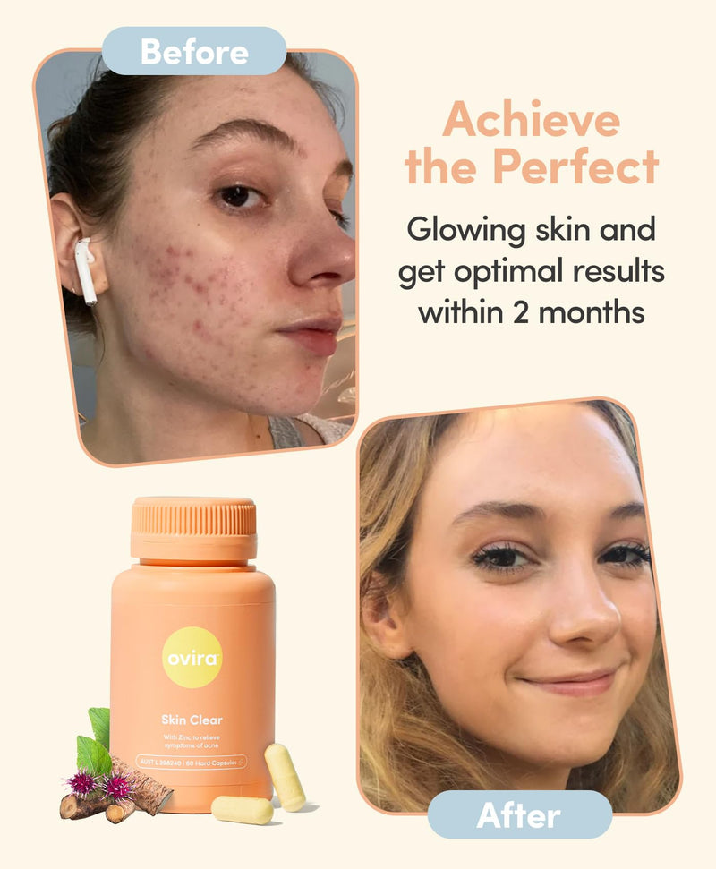 Ovira Skin Clear with ZINCBRIGHT - 60 Capsules for Clear & Glowing Skin | Rosacea & Hormonal Acne Treatment with Vitamin C | Support Collagen Production | Acne Supplements for Women & Men - Pack of 1