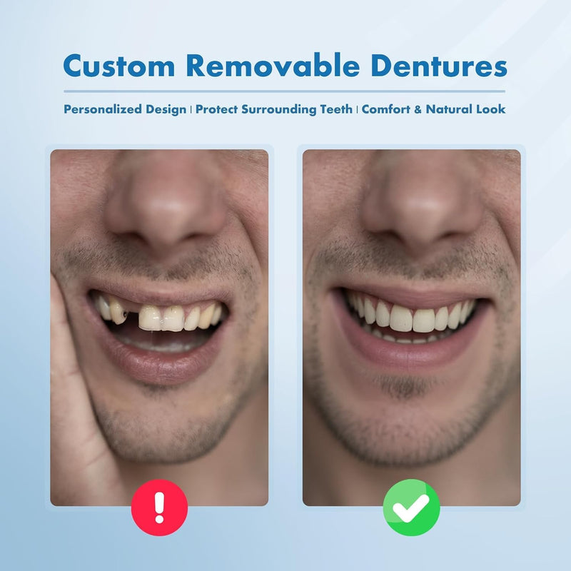 Partial Dentures - Custom Removable Tooth Replacement for Missing Teeth (1 Tooth)