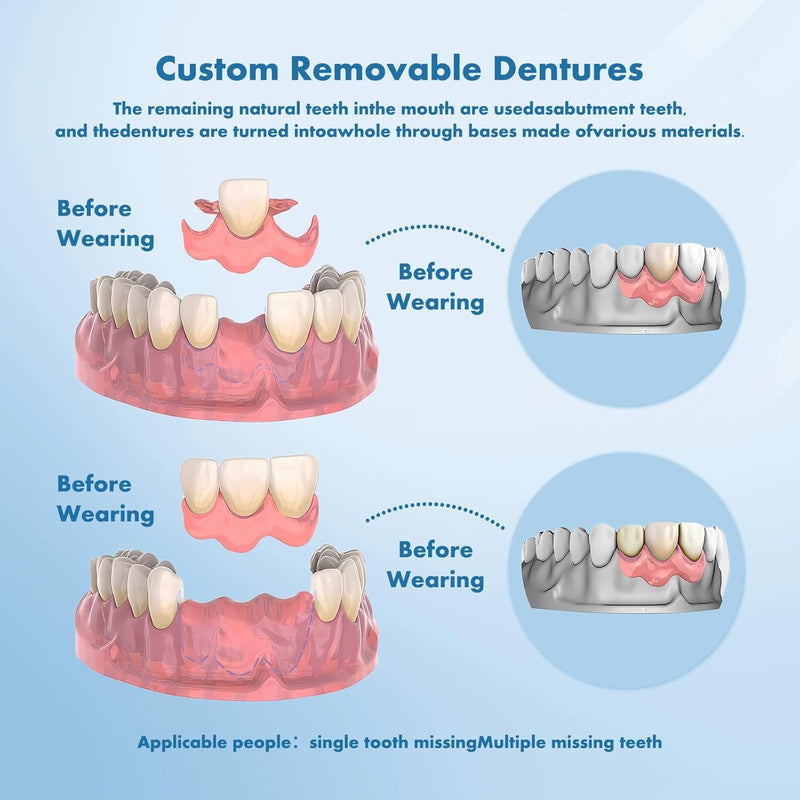 Partial Dentures - Custom Removable Tooth Replacement for Missing Teeth (1 Tooth)