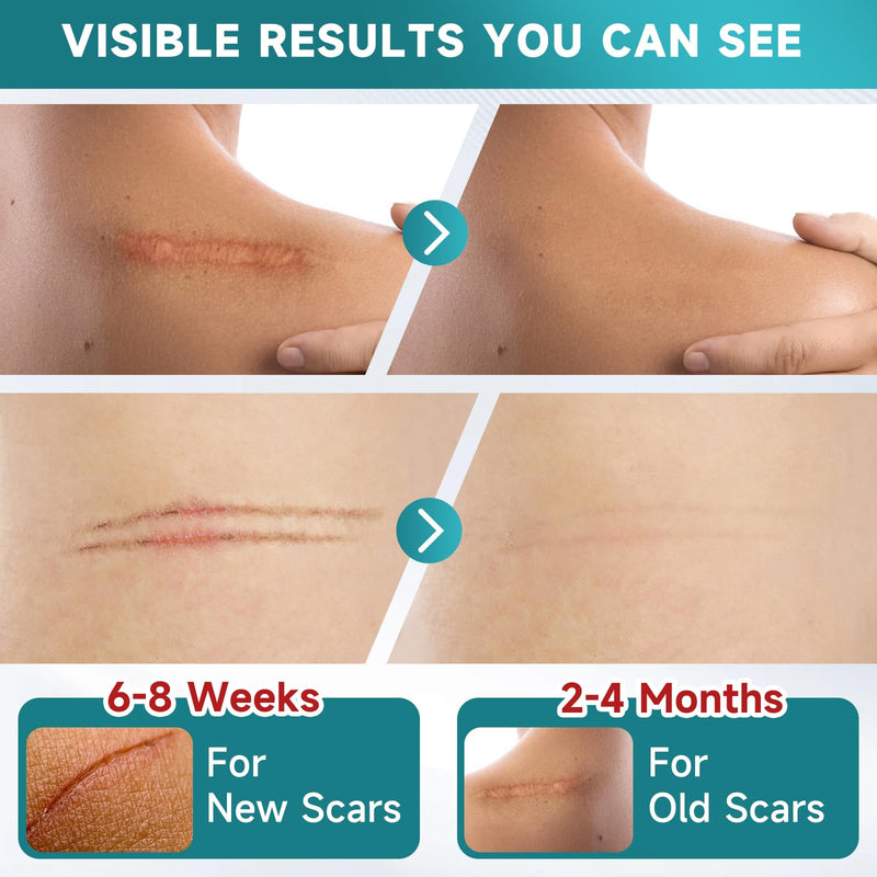 Pumkot Silicone Scar Sheets & Tape – 1.6”x60” Roll for Surgical Scars, C-Section & Burns