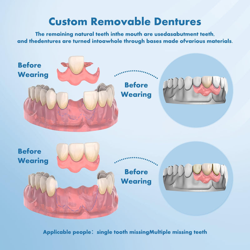 Custom Removable Dentures – Personalized Partial Dentures with Storage Case (1-6 Teeth)