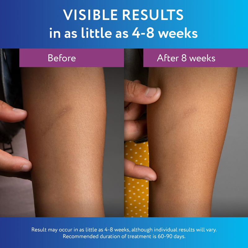 ScarAway Silicone Scar Gel – Improve Size, Color & Texture of Hypertrophic & Keloid Scars (10g)