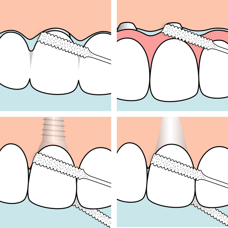 TePe Bridge & Implant Floss for Implants, Bridges & Braces – 30 Pieces