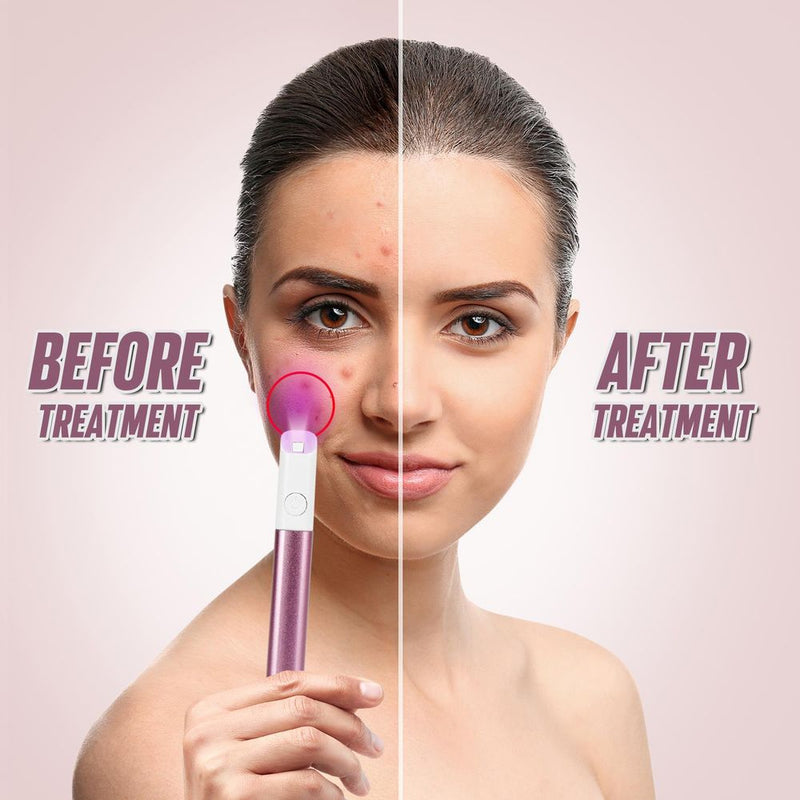 ASAB Light Therapy Acne Spot Treatment - Pink AS-61683