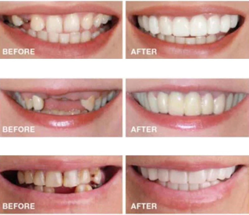 2 Pairs Temporarily Adjustable Smile Aligners – Natural & Comfortable for Men & Women (White)