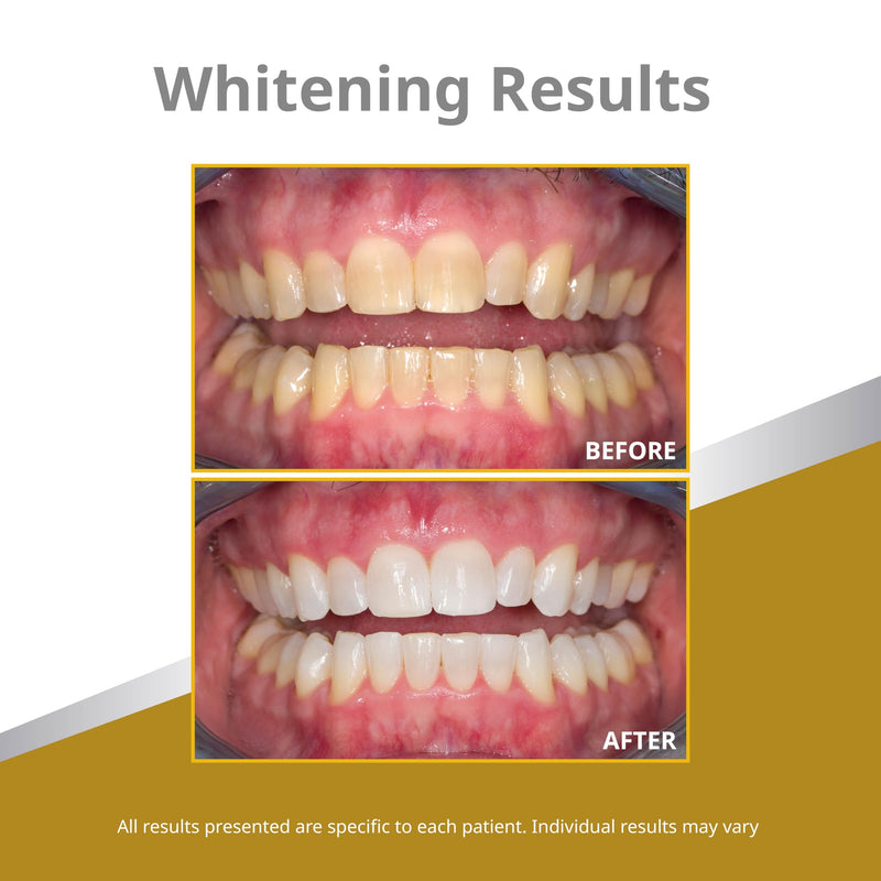 Opalescence 45% Teeth Whitening Gel – 8-Syringe Refill Kit (Mint, PF) by Ultradent