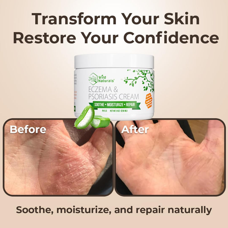 Wild Naturals Eczema & Psoriasis Cream — Manuka Honey + Aloe, Hydrating Lotion for Dry Skin (Adults & Kids)